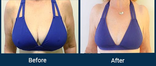 Breast Implant in Indore Bhopal, Breast Enlargement in Indore Bhopal, Breast Augmentation in Indore Bhopal, Breast Implant Surgery Cost in Indore Bhopal, Breast Implant Price in Indore Bhopal